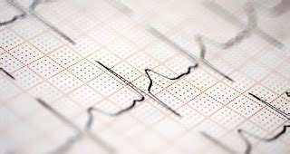 Idioventricular Rhythm Meaning, Rate, ECG, Causes, Treatment - Health Care Tips and Natural Remedies