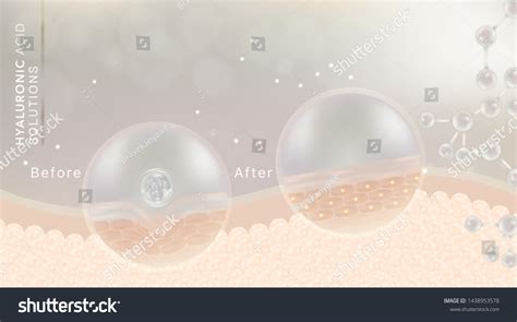 Hyaluronic Acid Before After Skin Solutions Stock Vector (Royalty Free) 1438953578 | Shutterstock