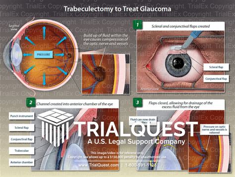 Trabeculectomy to Treat Glaucoma - TrialQuest Inc.