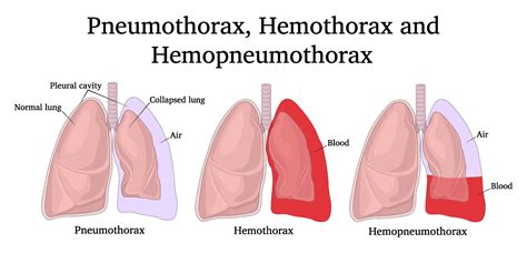 Thoracic Trauma - Pneumothorax - High Peak First Aid