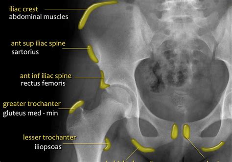 Hip X Ray Anatomy