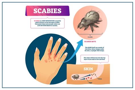 Scabies: Symptoms, Causes, Prevention, & Treatment