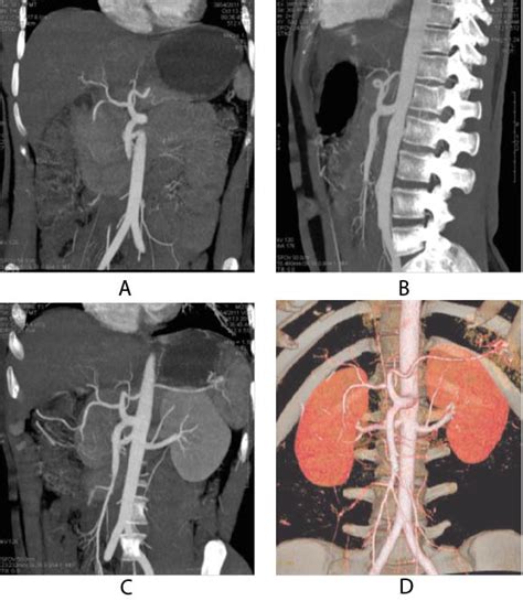 Common Origin of Celiac and Superior Mesenteric Arteries as Celiacomesenteric Trunk: Case Report ...