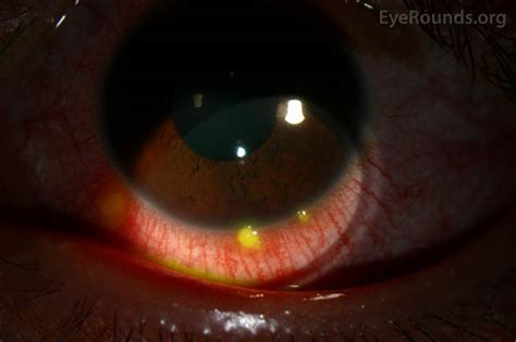 Phlyctenular Conjunctivitis