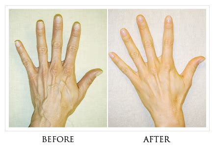 Hand Vein Removal - Sarasota Vascular Specialist