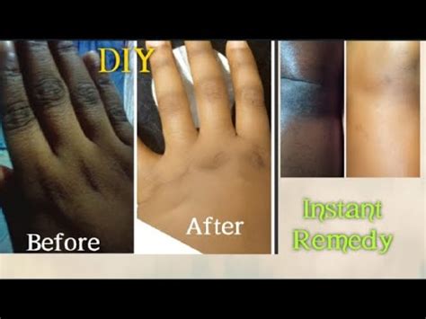 HOW TO GET RID OF DARk KNUCKLES & DARK KNEES INSTANTLY| DIY CLEAR % LIGHTEN KNUCKLES FAST - YouTube