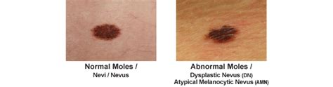 Mole Examination & Treatment Orlando | Associates In Dermatology