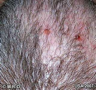 Morgellons skin symptoms