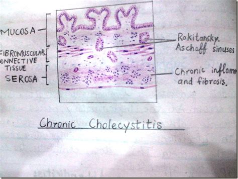 Histology Slides Database: Chronic Cholecystitis histopathology diagrams