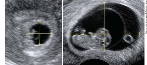 [PDF] Normal Ranges of Embryonic Length, Embryonic Heart Rate ...