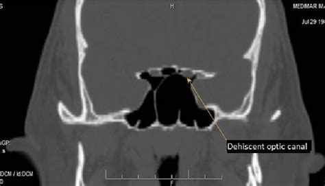 Dehiscence of the optic canal with secondary septum anchored on ...