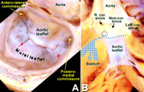 Tee Mitral Valve Leaflet Anatomy | My XXX Hot Girl