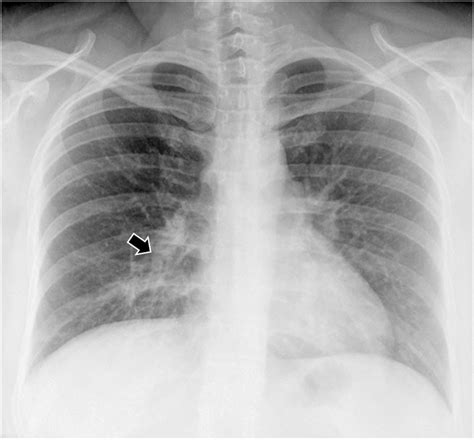 Chest X Ray In Pneumonia