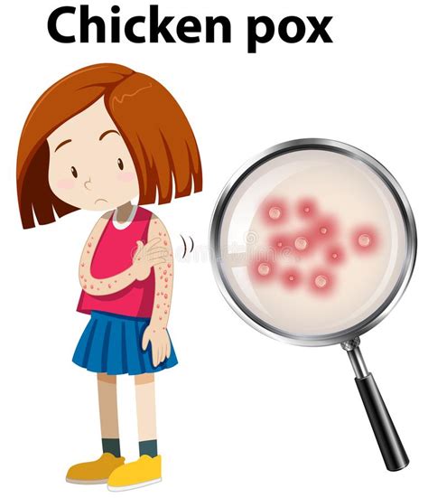 chicken pox clipart 20 free Cliparts | Download images on Clipground 2024