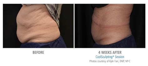 CoolSculpting before and after | Real Patient Results