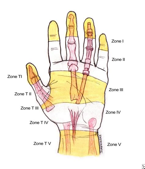 Flexor Tendon Zones Forearm