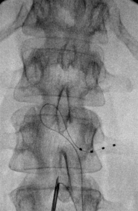 Advanced Image-Guided Procedures for Painful Spine - Neuroimaging Clinics