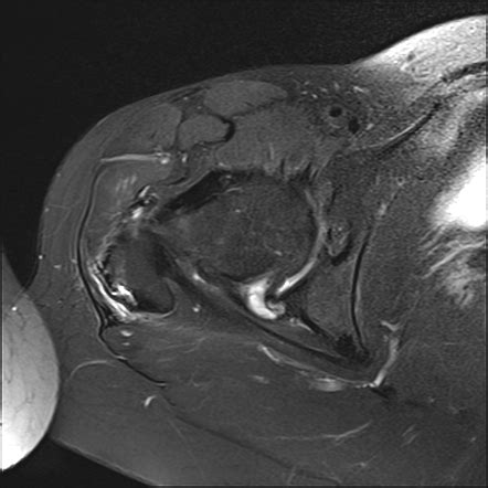 Gluteal tendinopathy | Radiology Case | Radiopaedia.org