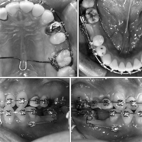 Le Fort I osteotomy with midpalatal osteotomy. Lower Le Fort I... | Download Scientific Diagram