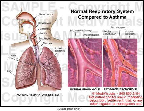 Asthma Lungs Compared To Normal Lungs