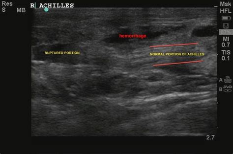 ultrasound of achilles tendon rupture