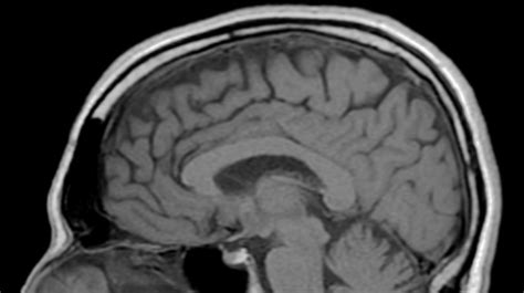 Pseudobulbar Palsy Life Expectancy, Causes, Treatment | Pseudobulbar Palsy vs Bulbar Palsy ...