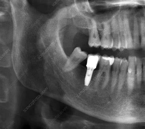 Dental Implant Xray