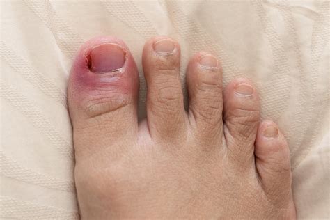 Big Toe Pain Archives - South Jersey Podiatrist | South Jersey Foot Doctor | Dr. Diana Tsombaris ...