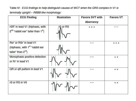 Differential Diagnosis of Wide QRS Complex Tachycardias