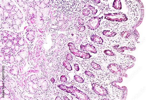 Histology of human tissue, show gastric mucosa intestinal metaplasia as ...