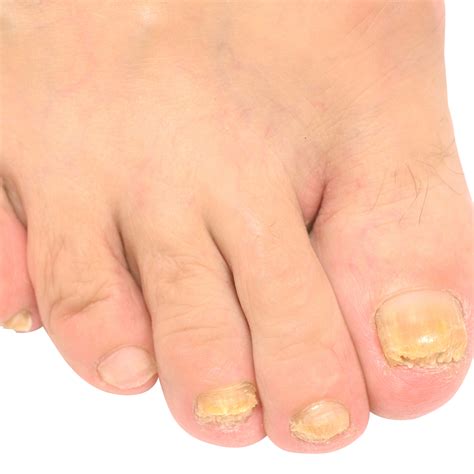 I think I have toenail fungus - Columbus Foot and Ankle