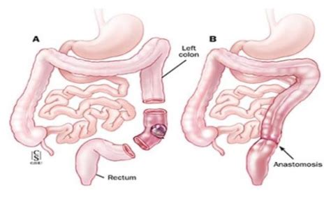 Sigmoid Colectomy - Milton Keynes University Hospital