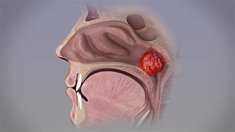 Adenoid Hypertrophy | Causes & Homeopathic Treatment