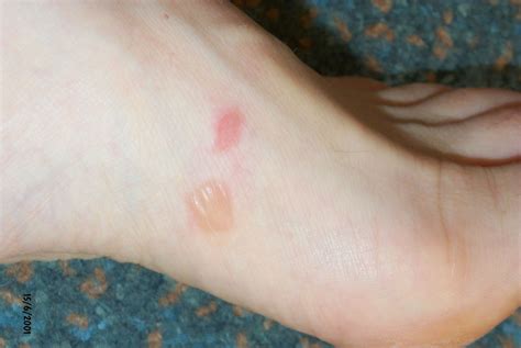 Friction Blisters: Causes, Treatment, Prevention