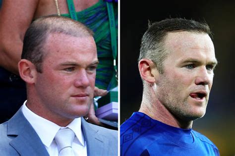 Wayne-Rooney-hair-transplant-before-and-after - Celebrities hair ...