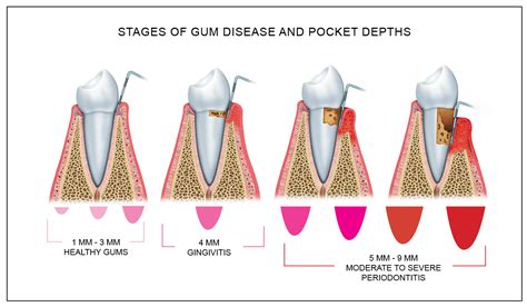 Periodontal Disease Grand Rapids | Near Me | Great Lakes Periodontics