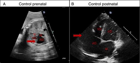 Right (atrial) appendage enlargement: Prenatal diagnosis and postnatal ...