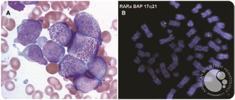 Acute myeloid leukemia pretreated with filgastrim mimicking acute promyelocytic leukemia
