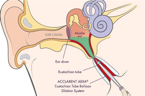 Eustachian Tube Dysfunction