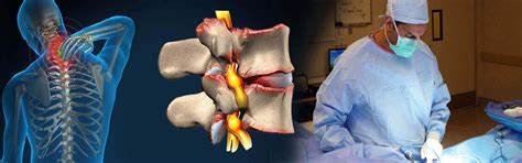 Spinal Stenosis Surgery In Enfield Town, Spinal Stenosis Surgery Hospital Enfield Town