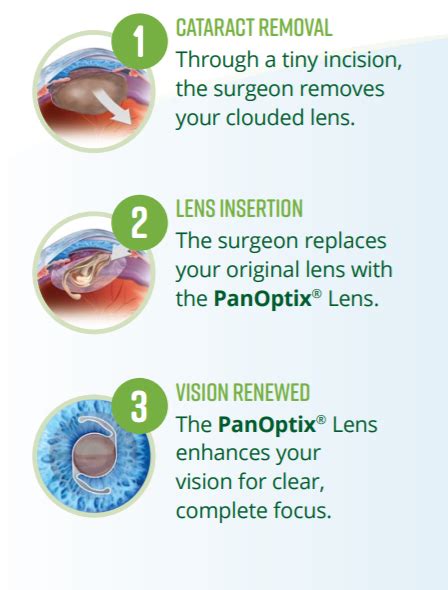 What Is The PanOptix Trifocal IOL? | Sugiki Portis Yim