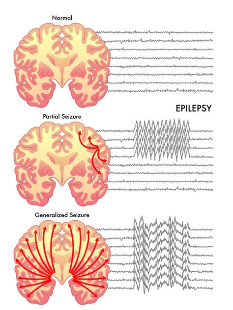 Seizure Overview - Harvard Health