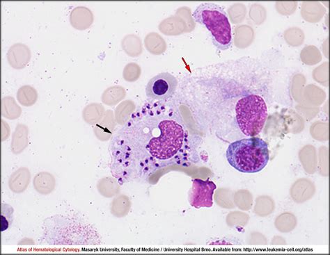 Visceral Leishmaniasis Disease