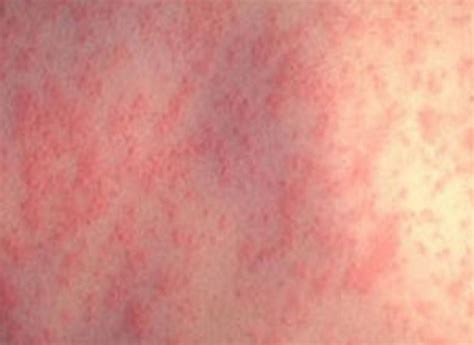 irritant dermatitis pictures | Symptoms and pictures