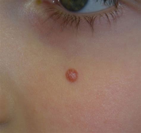 Spitz nevus - Dermatology Advisor