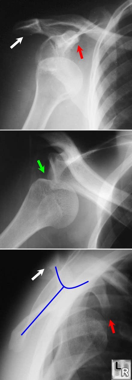 Learning Radiology - Dislocation, Shoulder, posterior, inferior ...