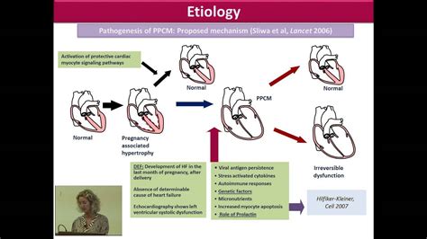 Peripartum Cardiomyopathy - YouTube