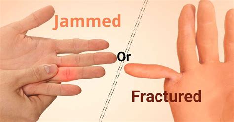 Have you Ever Jammed or Fractured your Finger? | Marham