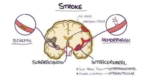 Subarachnoid Hemorrhage Vs Intracerebral Hemorrhage