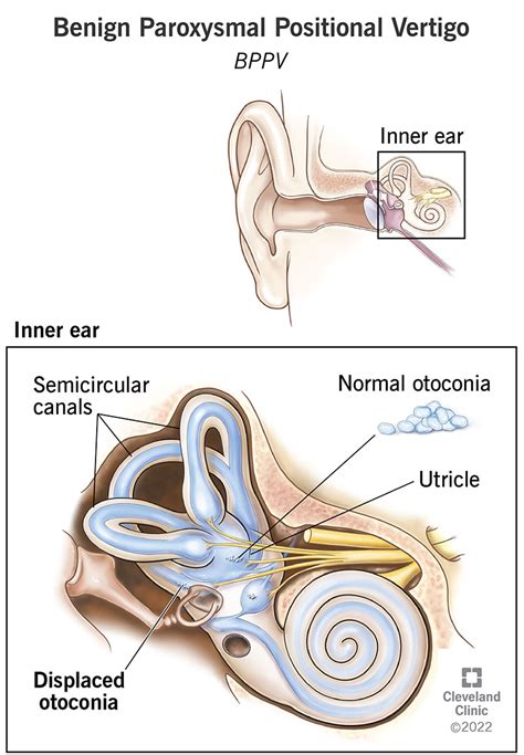 Benign Paroxysmal Positional Vertigo (BPPV) - Cleveland Clinic